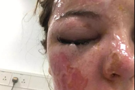 Девушка вынула яйца из микроволновки и ослепла Девушка вынула яйца из микроволновки и ослепла