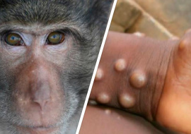 ВСЗ официально объявила оспу обезьян пандемией