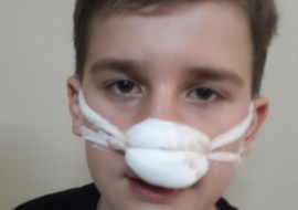 Как выглядит сломанный нос у ребенка фото