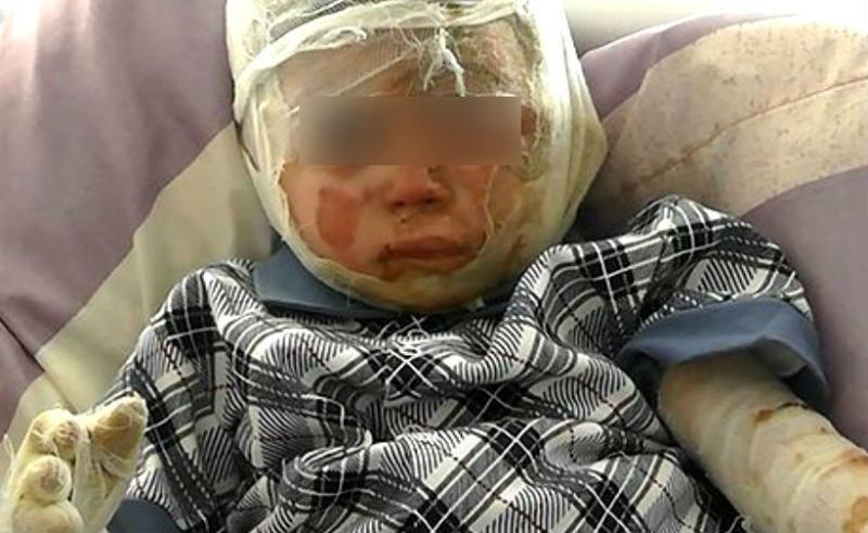 Ребенка обожгли на его дне рождения Ребенка обожгли на его дне рождения