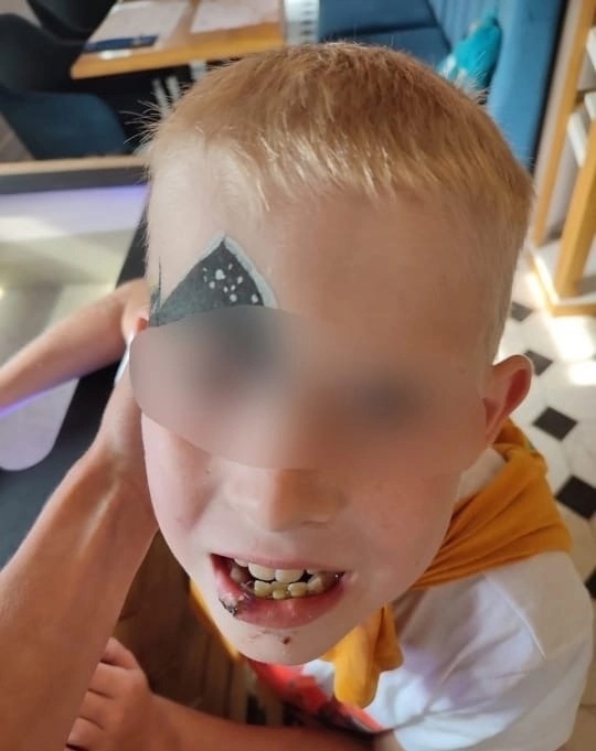 Семилетний ребенок лишился зубов из-за упавших на него ворот